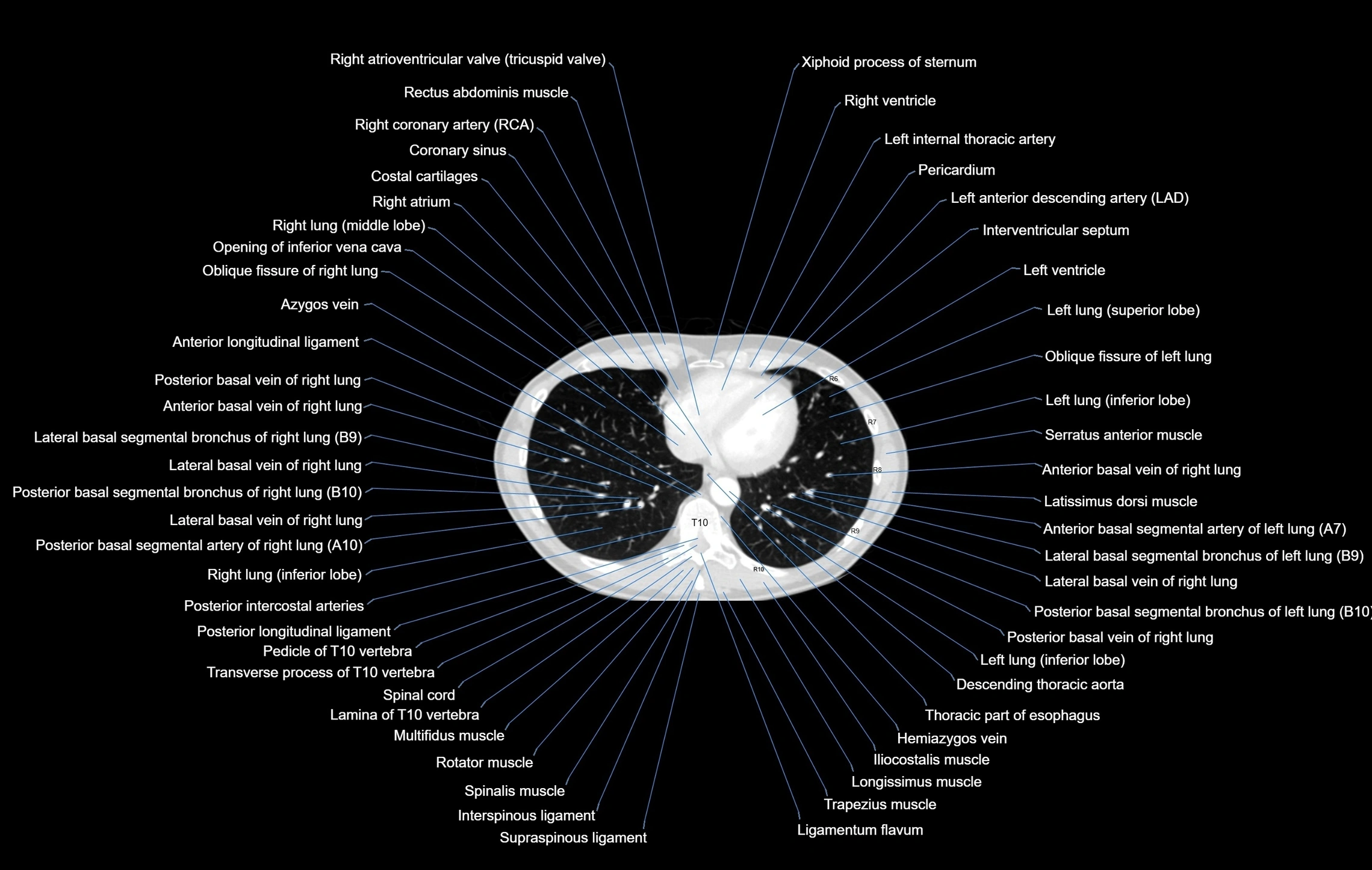 CT chest (thorax) lung window window labelled axial cross sectional anatomy radiology image-00087.webp